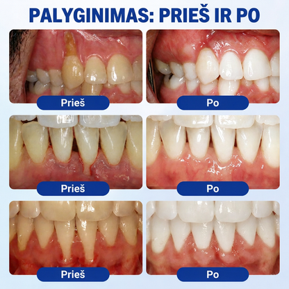 Rekomenduojamas odontologų 👨‍⚕️🦷🛡️ Vitalisys® GumRevive – regeneruojantis dantenų gelis 🐟❤️