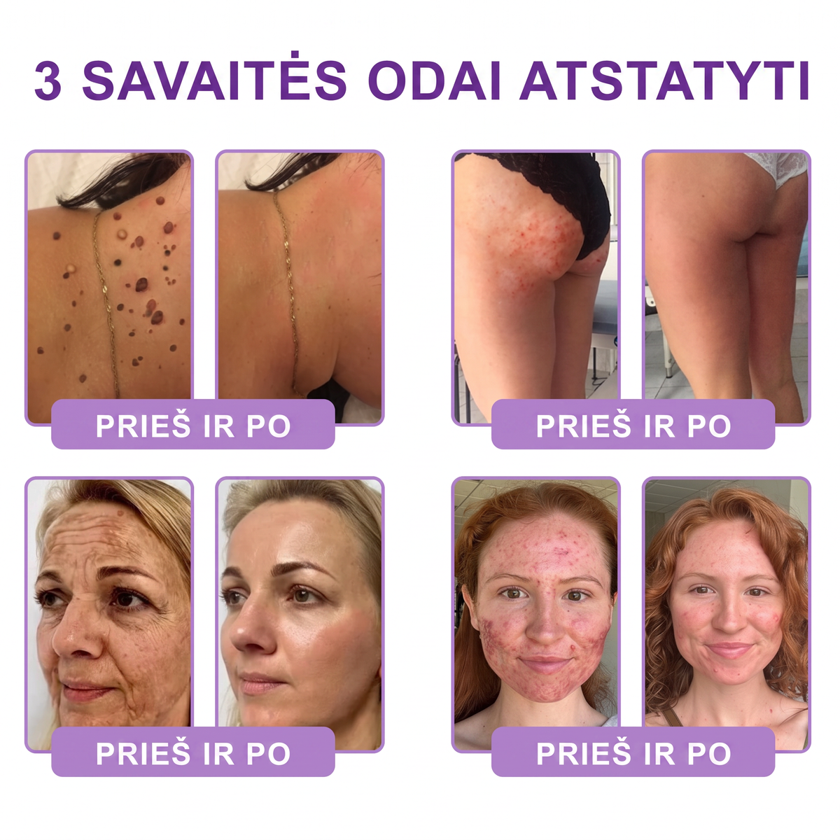 Ekspertų rekomenduojama🥦 |🌥️Vitalisys® PDRN“daugiapeptidis masažuojamasis kūno kremas – Anti-senėjimo, drėkinamasis,stangrinamasis,odą regeneruojantis,sulyginantis,spuogų ir dėmių šalinimo,karpų ir apgamų šalinimo, psoriazės palengvinimo priemonė.👒