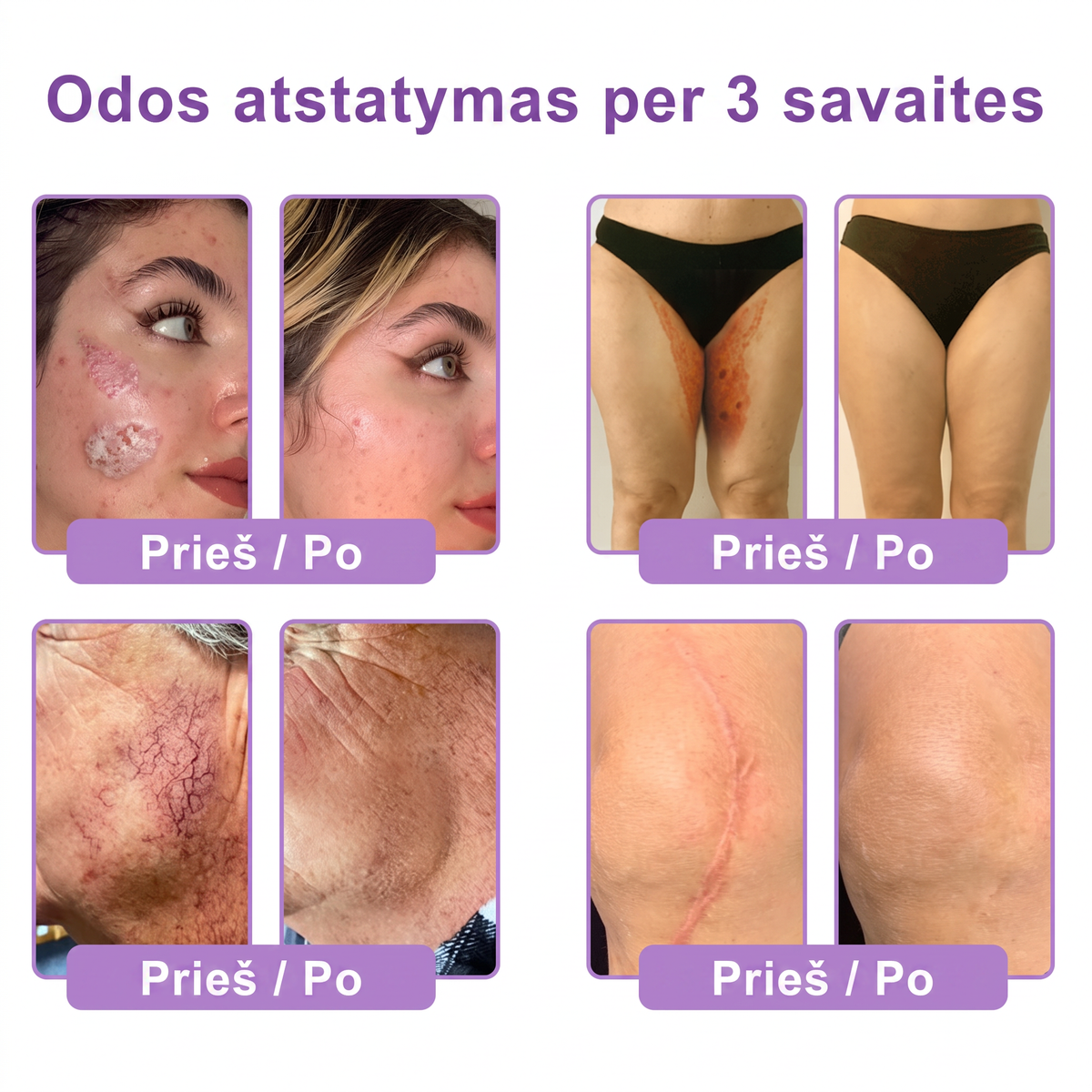 Ekspertų rekomenduojama🥦 |🌥️Vitalisys® PDRN“daugiapeptidis masažuojamasis kūno kremas – Anti-senėjimo, drėkinamasis,stangrinamasis,odą regeneruojantis,sulyginantis,spuogų ir dėmių šalinimo,karpų ir apgamų šalinimo, psoriazės palengvinimo priemonė.👒
